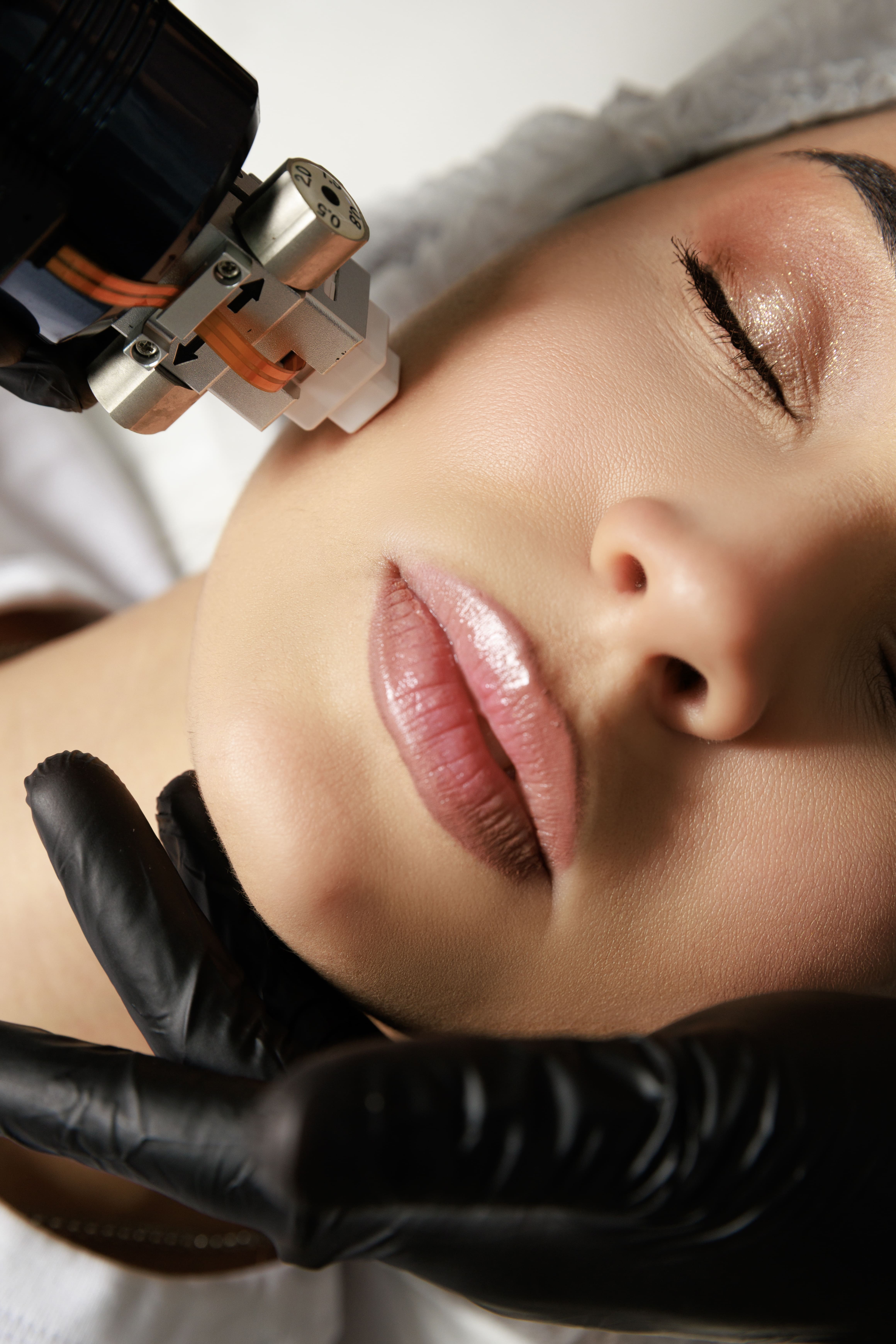 RF MICRONEEDLING  FACE + NECK + DE՛COLLETE՛