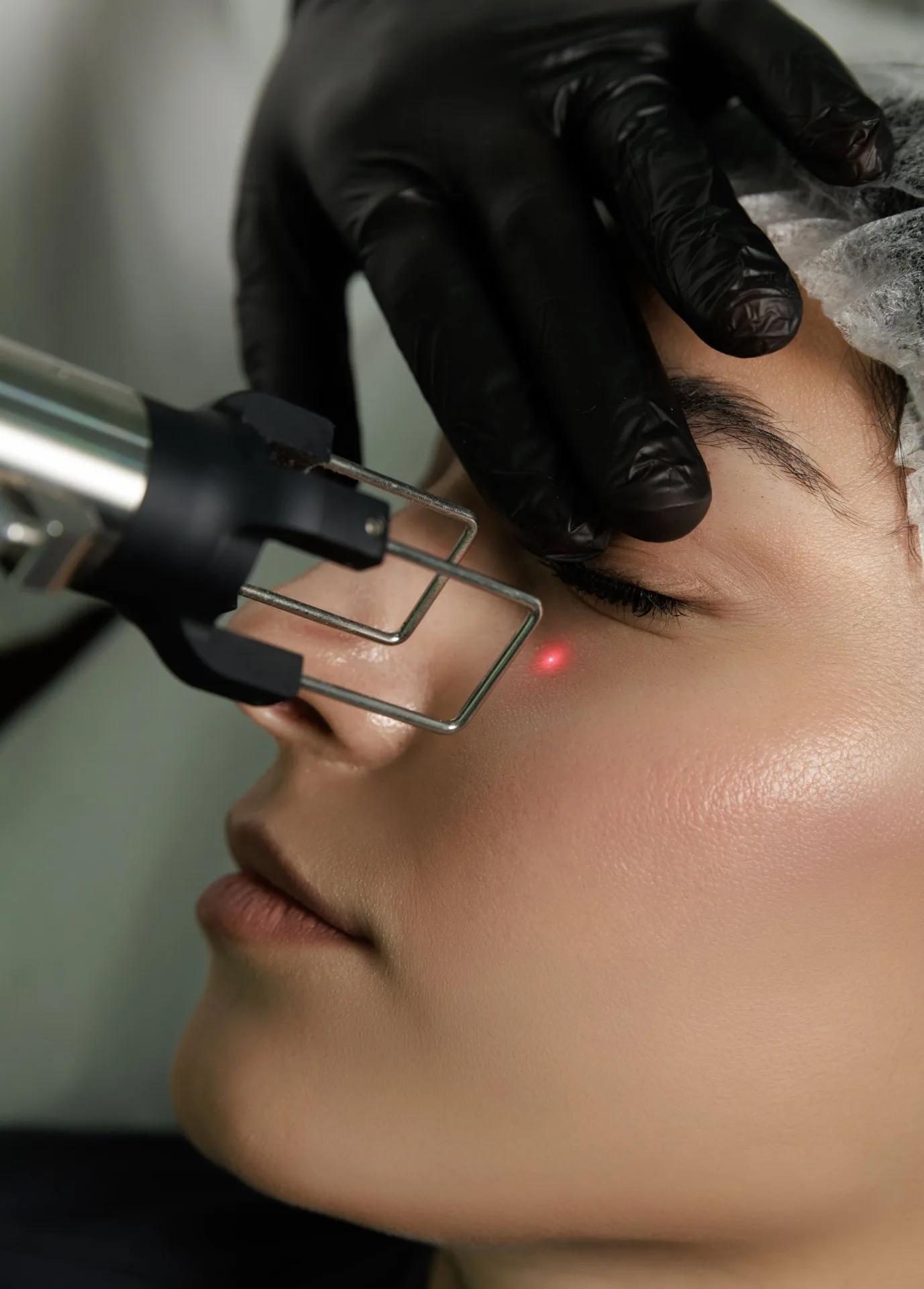 COOL PEEL CO2 LASER | CHEEKS OR FOREHEAD LASER RESURFACING/SCAR CORRECTION