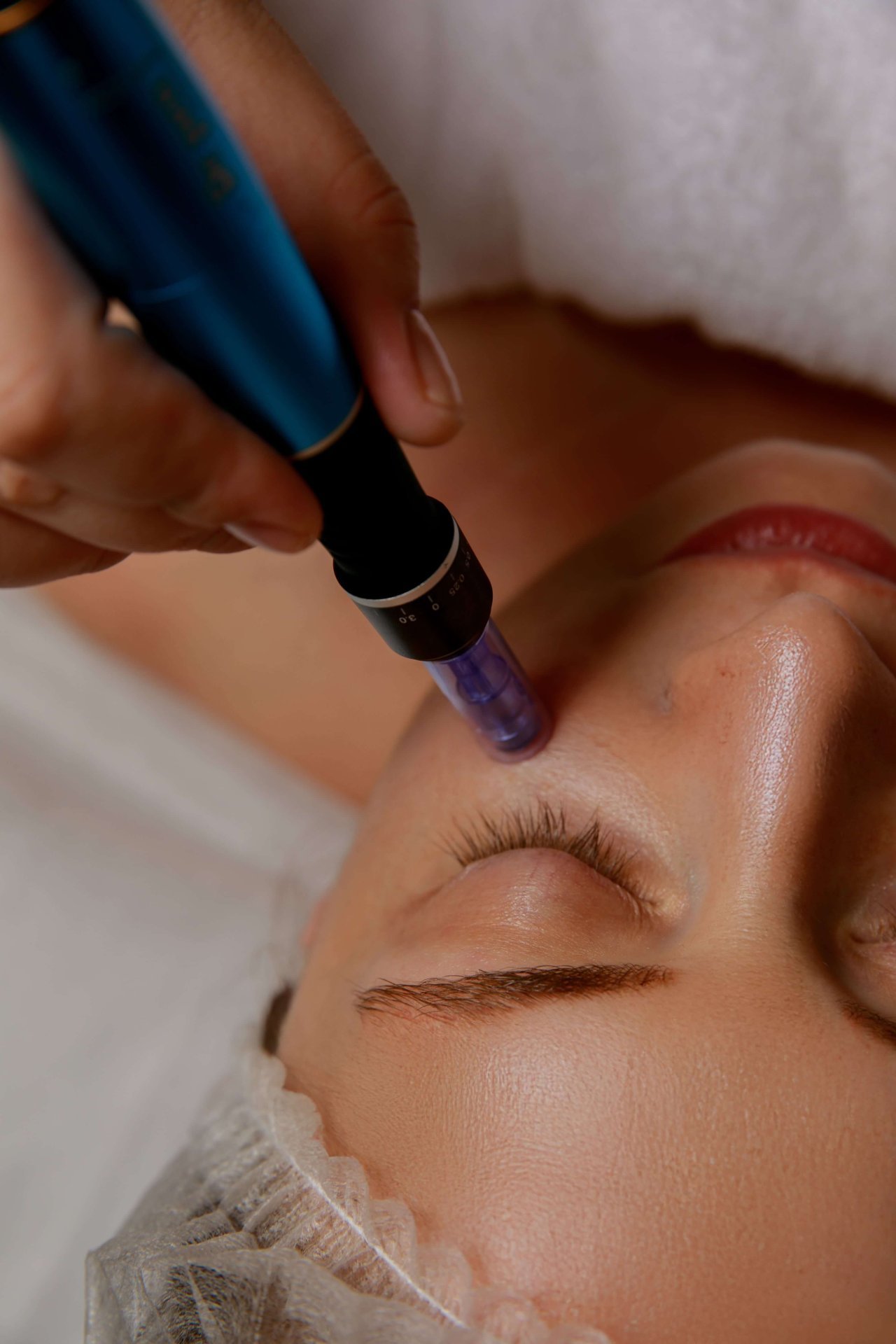 PRP THERAPY + MICRONEEDLING | VAMPIRE FACIAL  | SENIOR SPECIALIST
