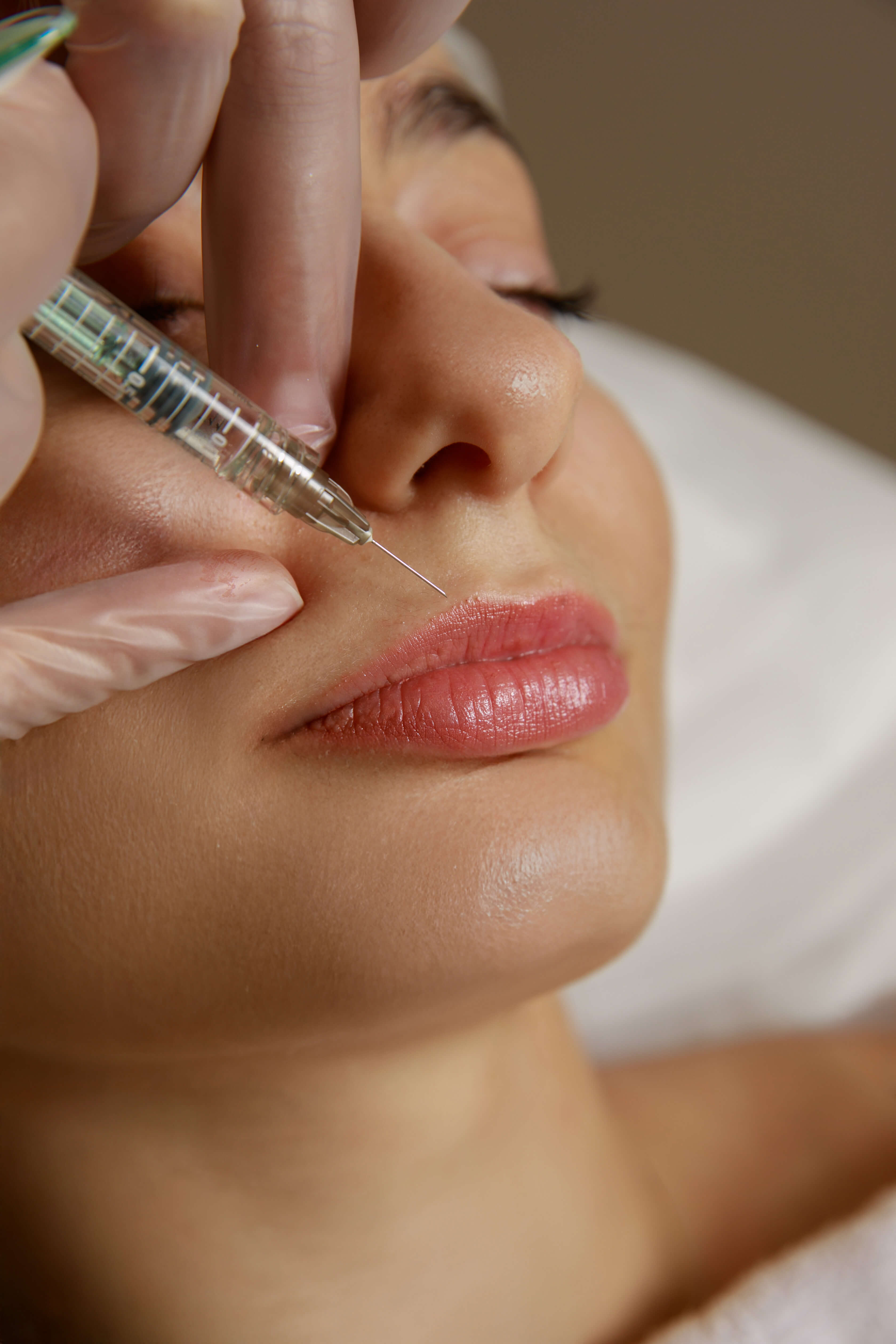 FILLER |  JUVEDERM ULTRA SMILE 1ml