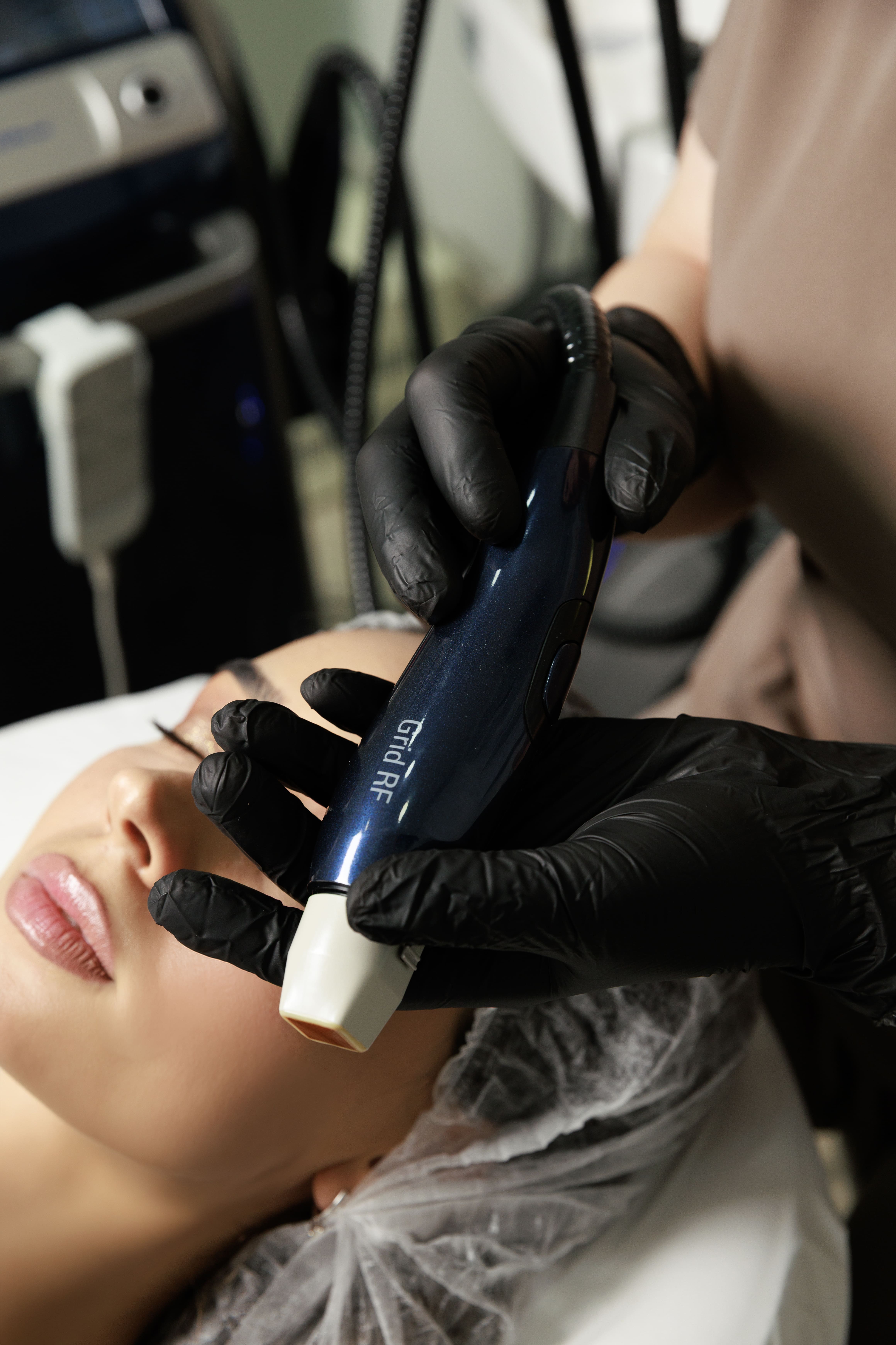 RF MICRONEEDLING SMALL AREA