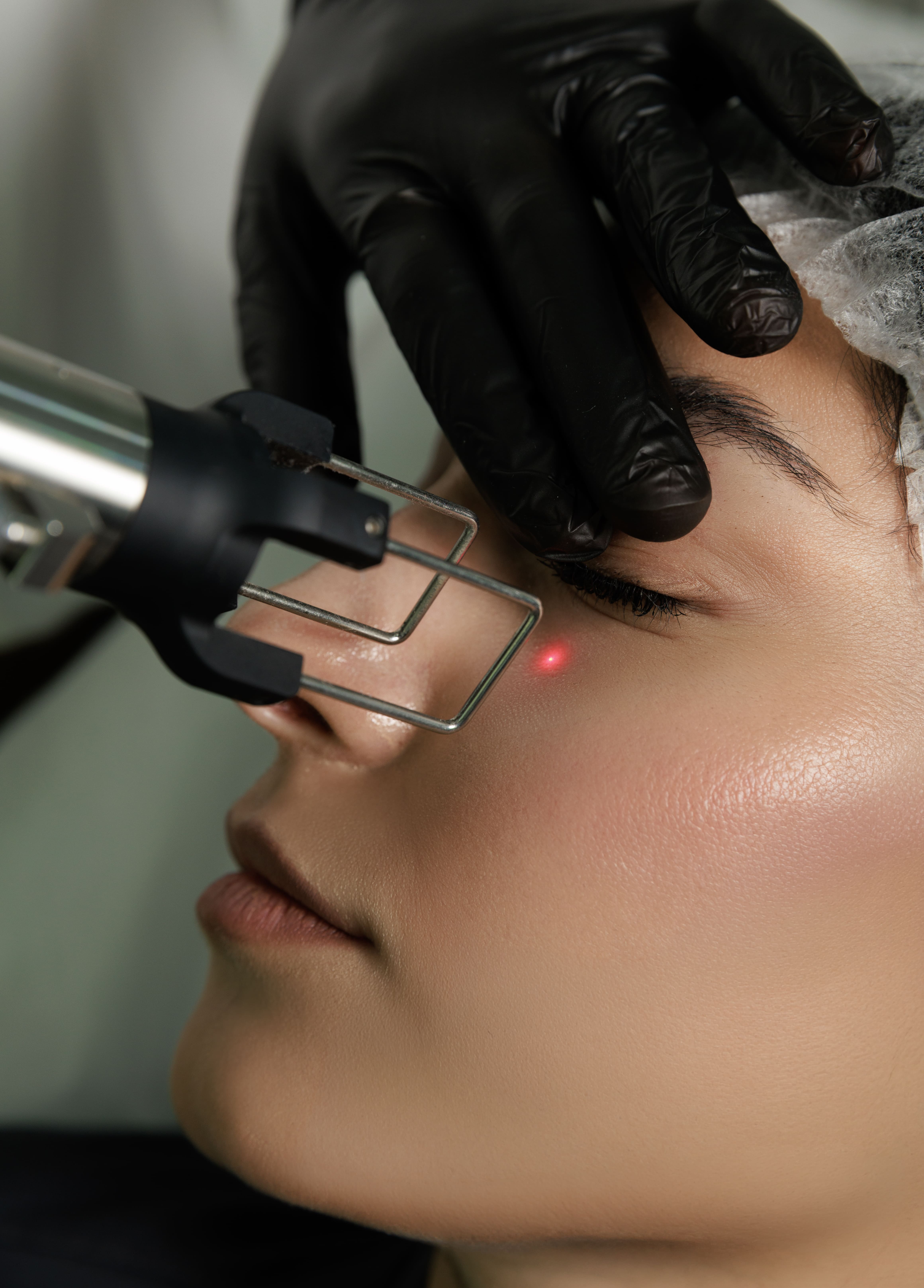 COOL PEEL CO2 LASER | CHEEKS OR FOREHEAD LASER REJUVENATION