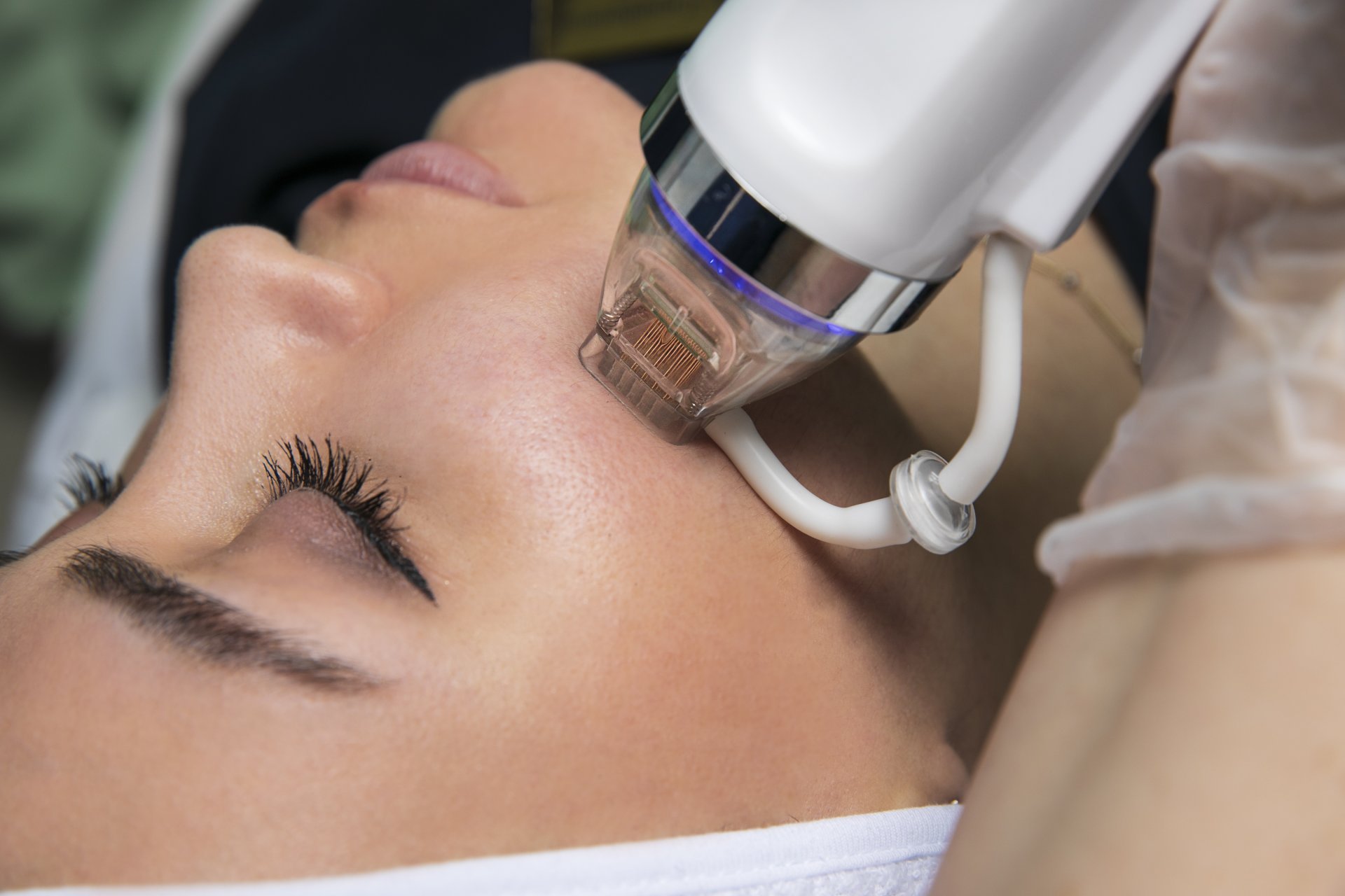 RF MICRONEEDLING | FACE + NECK + DÉCOLLETÉ