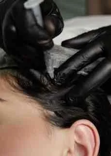 SCALP BOTULINUM TOXIN THERAPY