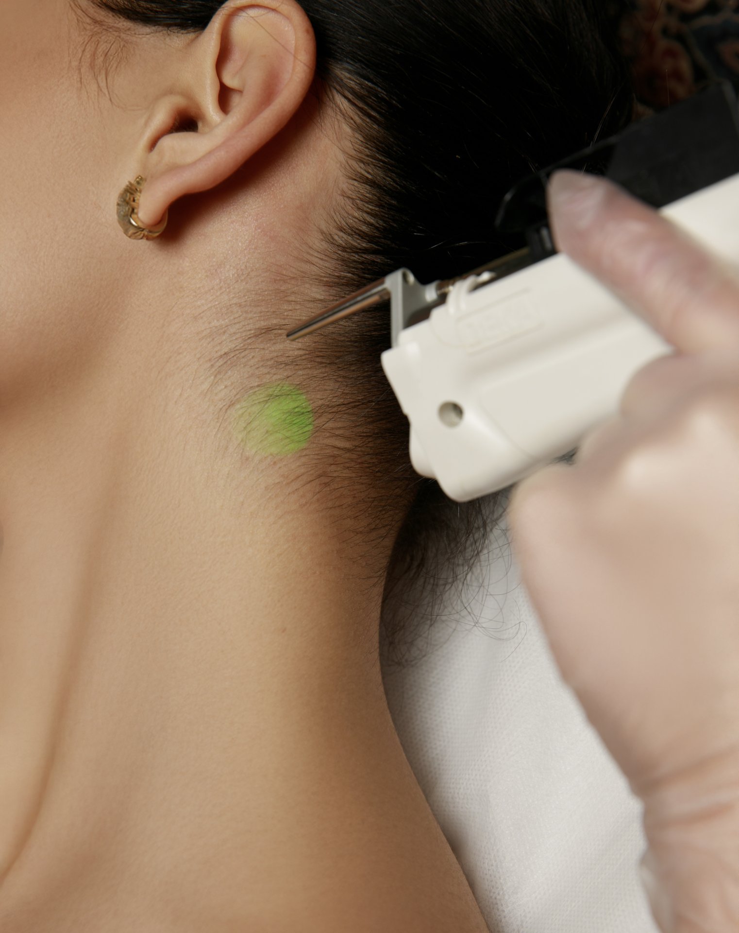 LASER DEKA MOTUS AX | FACE + NECK ( BACK AND FRONT )