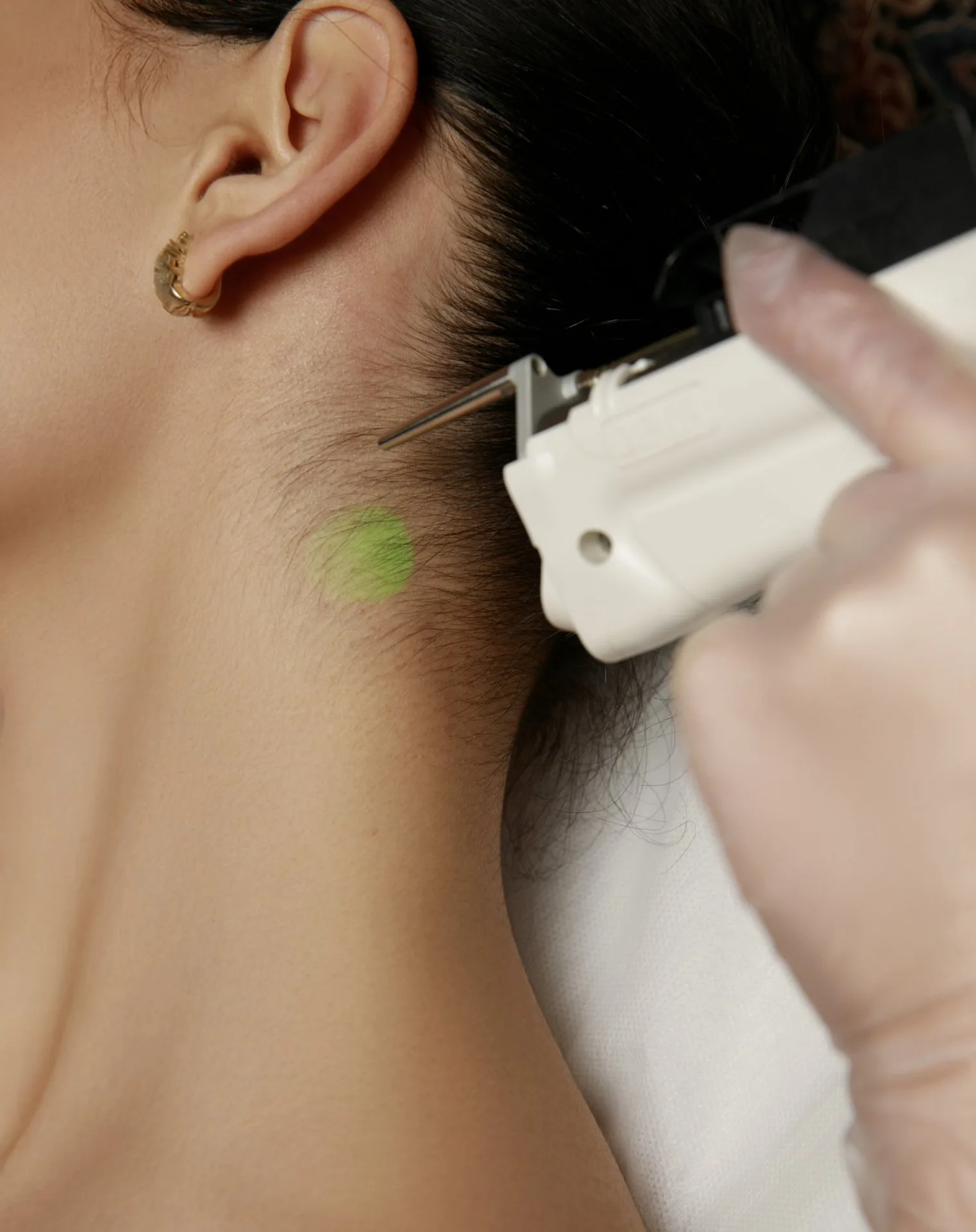 LASER DEKA MOTUS AX | FACE + NECK ( BACK AND FRONT )